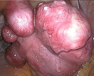 Pictures of Fibroids